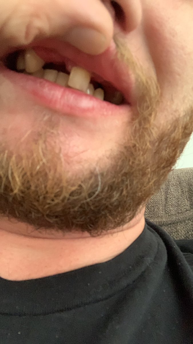 MrMandolinMan's tweet photo. @pulte I know it’s a long shot but I’ve suffered both physically and mentally with my teeth for a long time and have no prospects of being able to afford to fix them any time soon… https://t.co/F2XVDZk0et