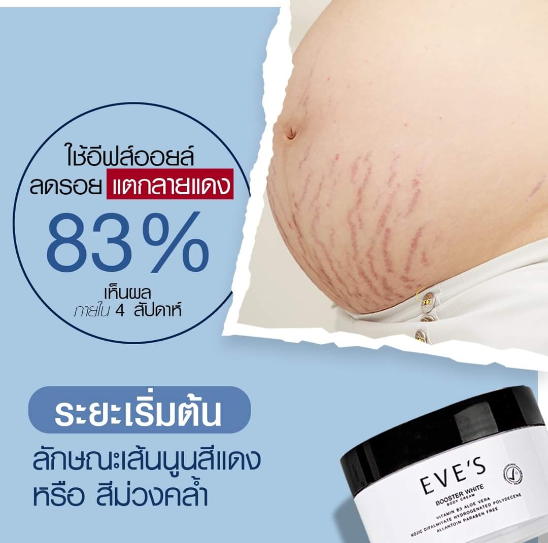 4PHhrT6Er4Hvcg8's tweet photo. ปัญหาท้องแตกลายของคุณแม่ ไม่ว่าจะระยะไหน??

คู่นี้ช่วยได้นะค้าาาา 🤰🏻✨

#EVESOIL #อีฟส์ออยล์ #บูสเตอร์อีฟส์
#อีฟส์สุราษฎร์ https://t.co/T7dDqWeNle