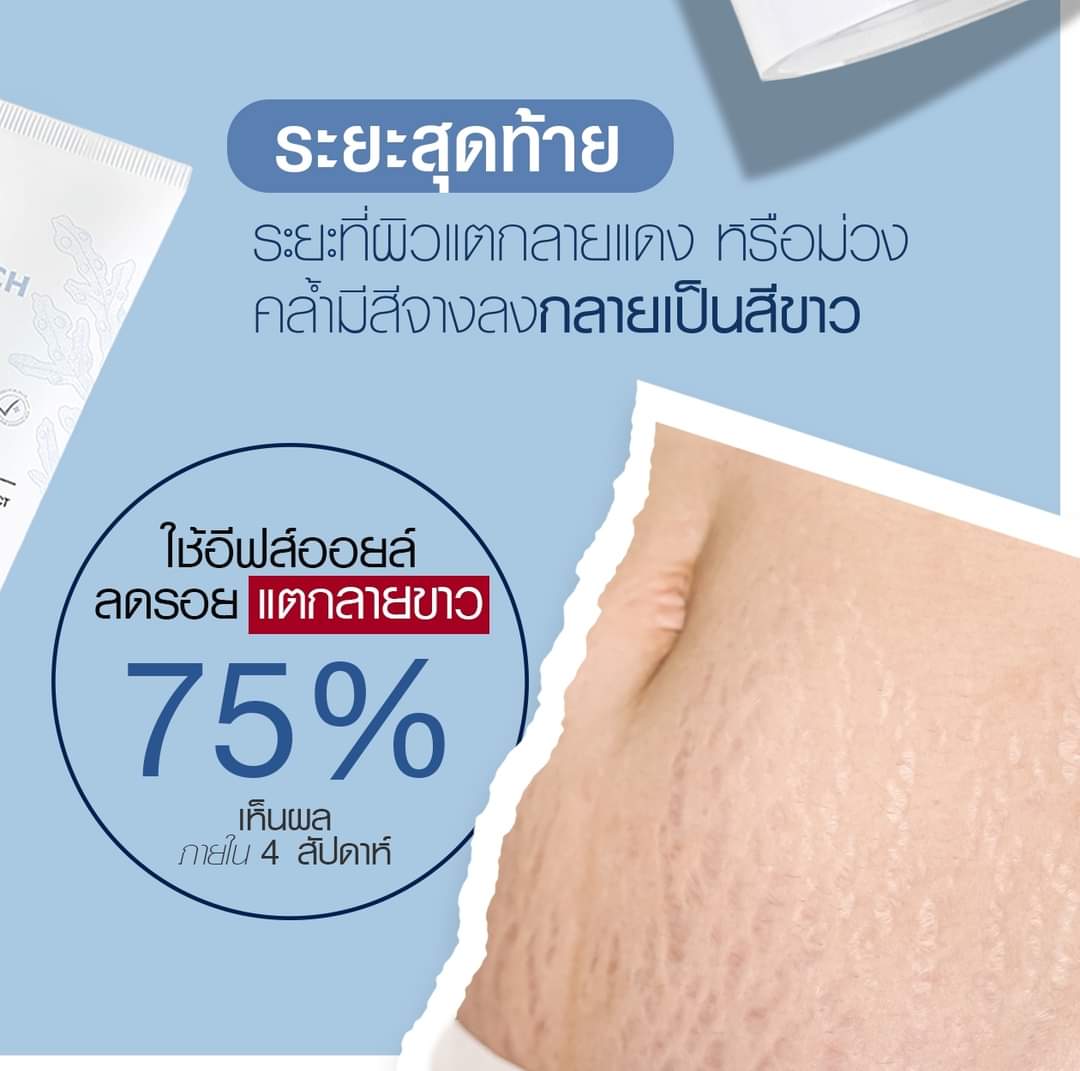 4PHhrT6Er4Hvcg8's tweet photo. ปัญหาท้องแตกลายของคุณแม่ ไม่ว่าจะระยะไหน??

คู่นี้ช่วยได้นะค้าาาา 🤰🏻✨

#EVESOIL #อีฟส์ออยล์ #บูสเตอร์อีฟส์
#อีฟส์สุราษฎร์ https://t.co/T7dDqWeNle