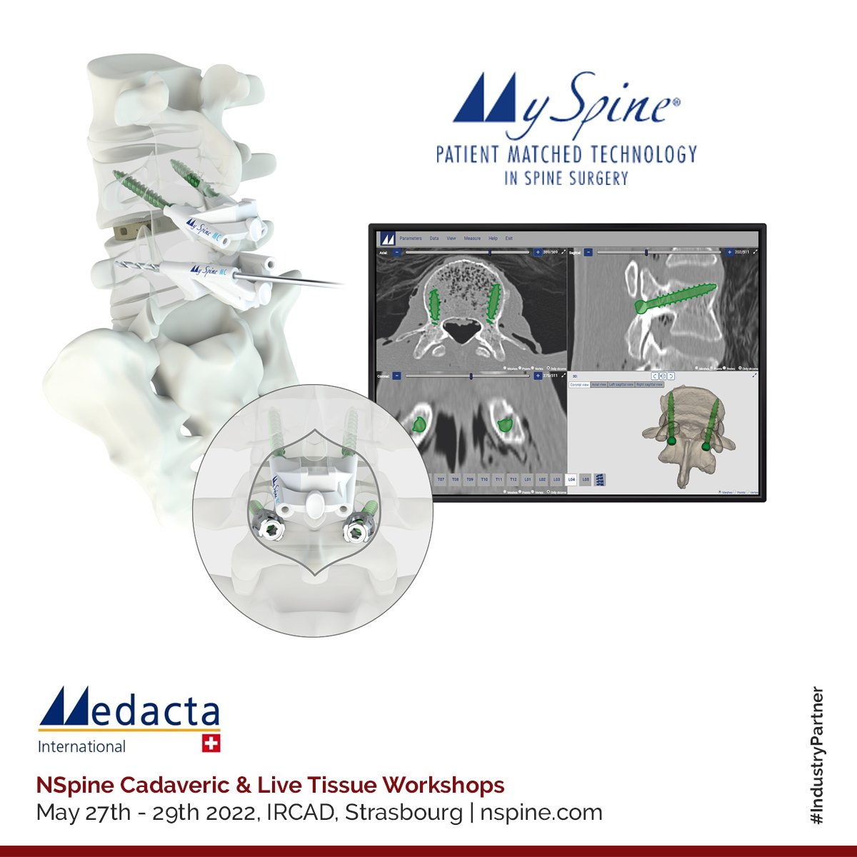 NSpine's pleased to welcome Medacta, a specialist in the design, production and distribution of innovative surgical products and techniques, and proud sponsors of the Combined Cadaveric &amp; Live Tissue Workshop, 27-29 May 2022, at the IRCAD, Strasbourg. 
buff.ly/3sXr3kA