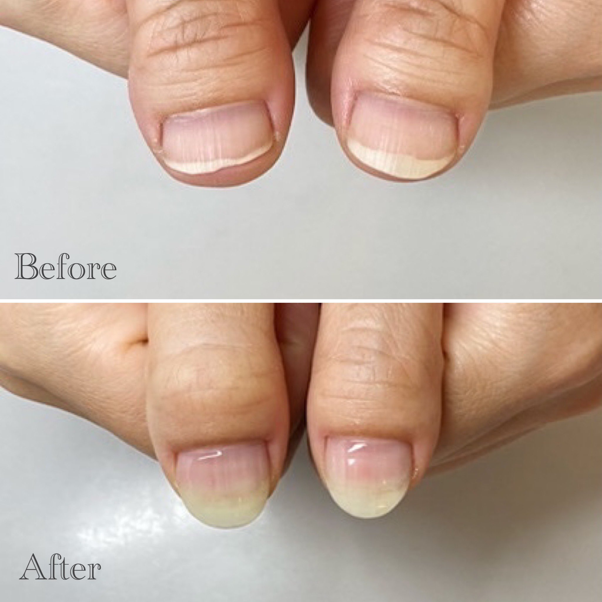 深爪矯正サロン ハンドとフット爪の長さだし 下北沢自爪育成ネイルサロン Nailsalonallume Twitter