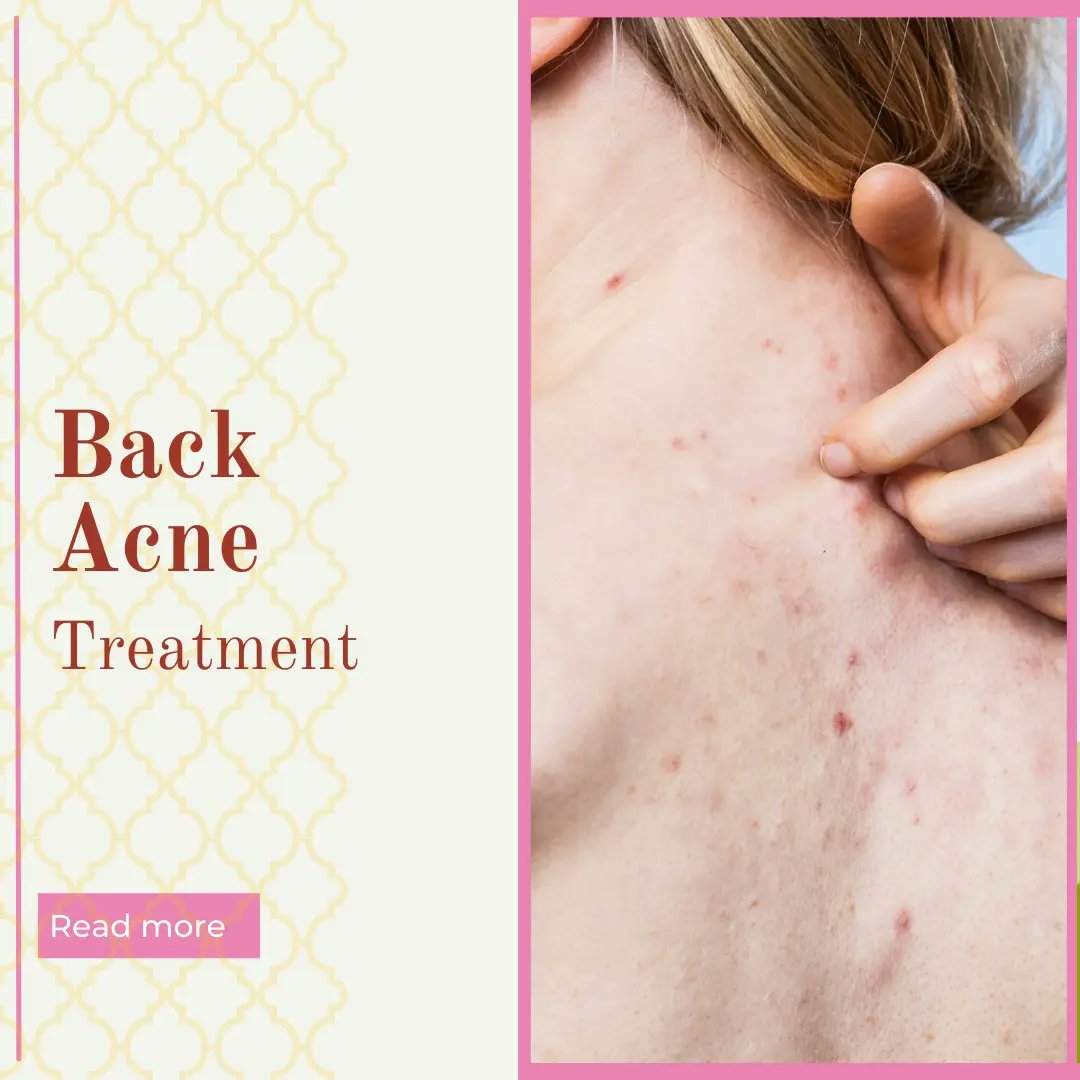 DrShrutikakar's tweet photo. Back Acne Treatment by Dr Shruti Kakar
Back acne is more common than you think and affects in general.
📧 shrutikakar1@gmail.com
📍 Specialist Dermatologist Medcare Al Barsha ,Dubai
#dermatology #cosmetics #backacne #doctor #dubai #india #tips #tricks #skincare #skin #health https://t.co/nxzO9GT3ma