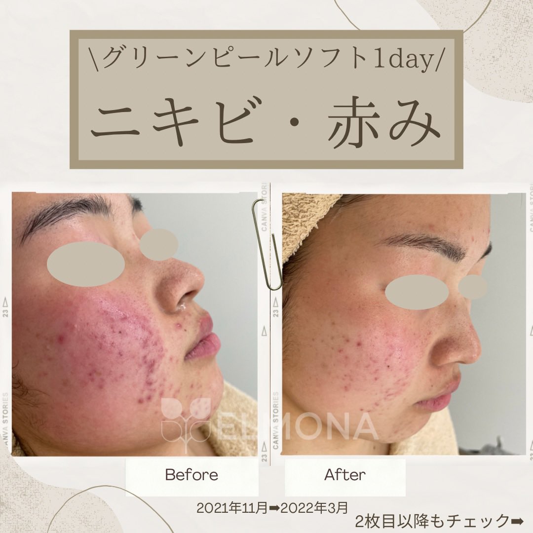 ハーブピーリング　グリンピール　松戸newオープン ハーブピーリング グリンピール 松戸newオープン