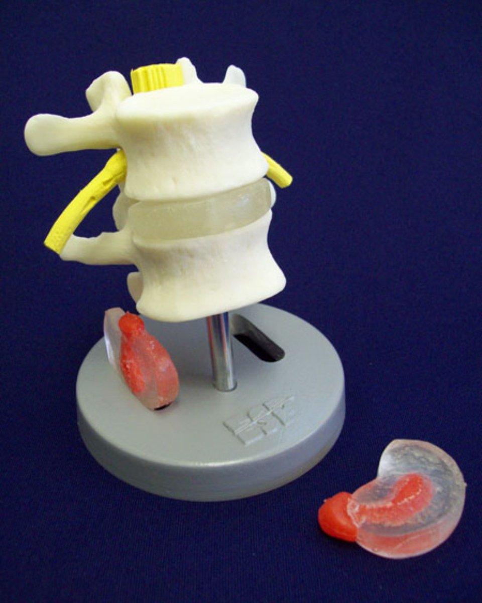 EMSPhysioLtdUK's tweet image. Two lumbar vertebrae with nerves. Supplied with three interchangeable discs, two herniated, one lateral, one dorsal and one normal disc. Mounted on stand but dissectible into 6 parts.

Buy online from EMS PHYSIO - just search EDC203 on our website
Link in BIO #lumbar #spinemodel