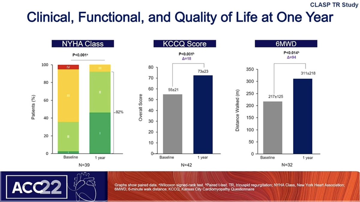 DrMarthaGulati's tweet photo. #ACC22 Transcatheter Tx Of TR: 1y Results Of The #ClaspTR Study
🫀Survival at 88% at 1 y
🫀TR ⬇️ to moderate or less, persist to 1 y
🫀Large ⬆️ in 6 min walk/QOL with TV repair
(this was an early feasibility study; await the ongoing studies) https://t.co/EdSF0T2bJr