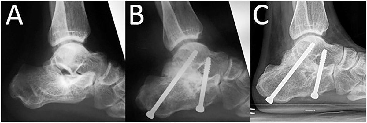 AOFAS_Journals's tweet image. A retrospective study of 100 patients who underwent operative treatment due to calcaneal malunions showed that patients with talar inclination angle greater than 6.5 degrees seem to have better functional outcomes at 2 years postop: ow.ly/OBH450IzJ8c