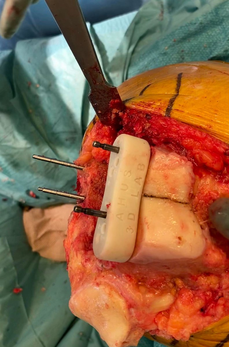 MTemmesfeld's tweet photo. "Notching" is a common challenge in total knee arthroplasty. An in-house designed and 3D printed "Anti Notching Guide" allows re-alignment of the femoral cutting block avoiding notching without losing rotational alignment. @randsborg  @Ahus_no @zimmerbiomet #orthotwitter https://t.co/6kmV3qSl8Q