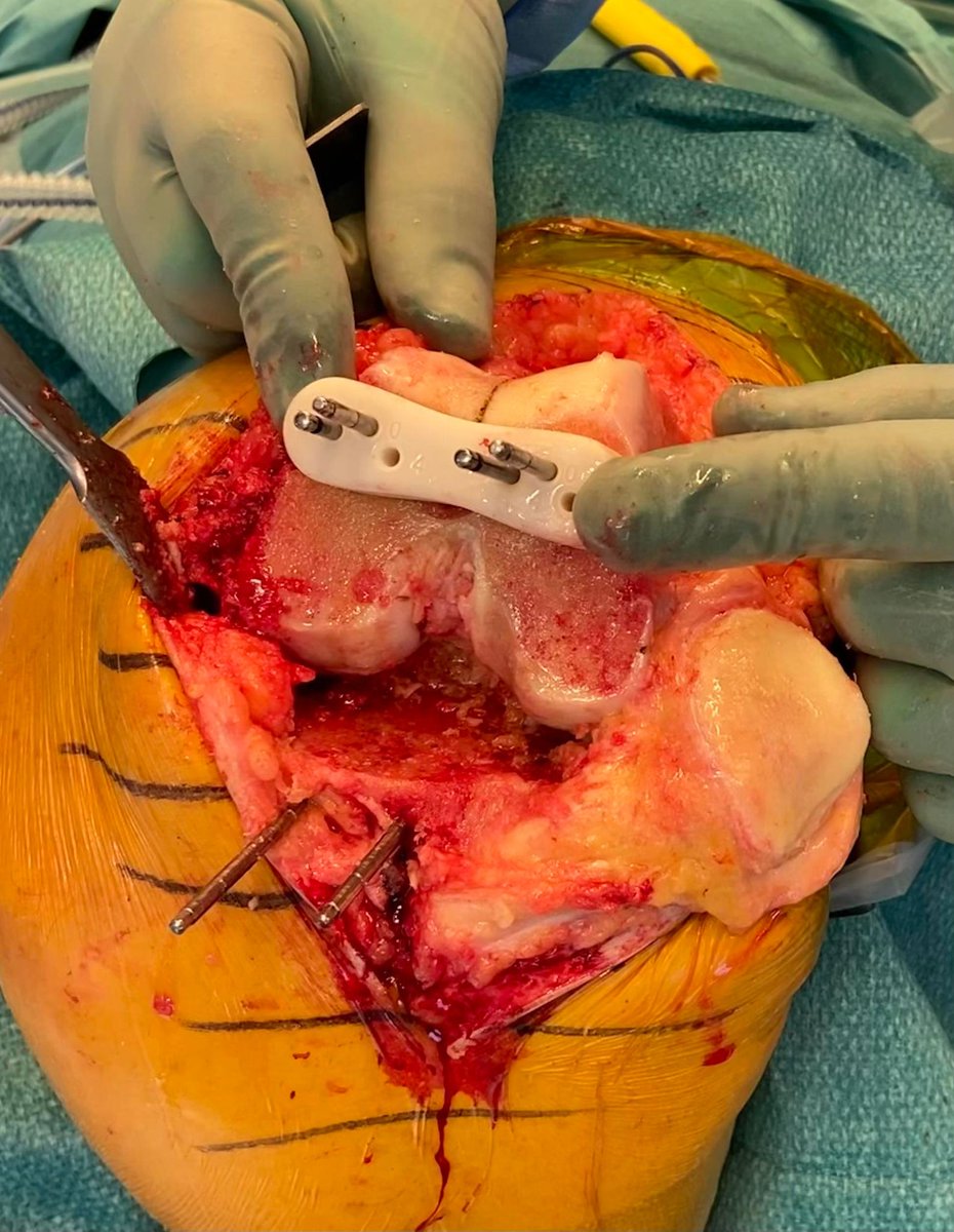 MTemmesfeld's tweet photo. "Notching" is a common challenge in total knee arthroplasty. An in-house designed and 3D printed "Anti Notching Guide" allows re-alignment of the femoral cutting block avoiding notching without losing rotational alignment. @randsborg  @Ahus_no @zimmerbiomet #orthotwitter https://t.co/6kmV3qSl8Q