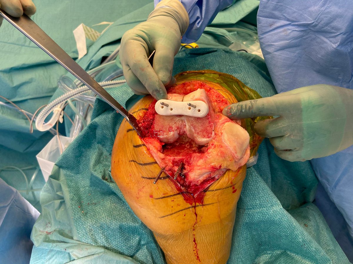 MTemmesfeld's tweet photo. "Notching" is a common challenge in total knee arthroplasty. An in-house designed and 3D printed "Anti Notching Guide" allows re-alignment of the femoral cutting block avoiding notching without losing rotational alignment. @randsborg  @Ahus_no @zimmerbiomet #orthotwitter https://t.co/6kmV3qSl8Q
