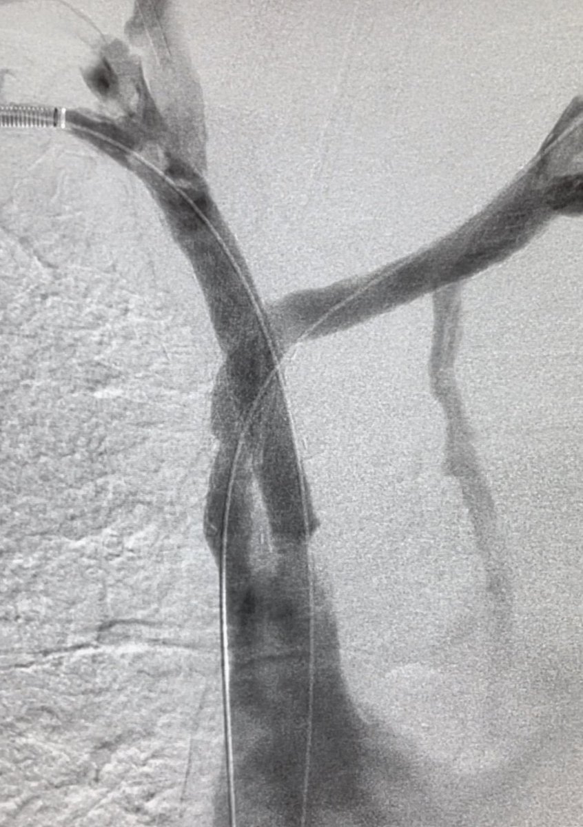 Pre and post sharp SVC recan. Symptom relief from PPD1. <a href="/angiowoman/">Janice Newsome MD FSIR</a> <a href="/JunManKimMD/">Junman Kim MD</a> @billmajdalany <a href="/DrFLoya/">Mohammed Faisal Loya, M.D.</a> <a href="/CHICKVIR/">Jeffrey F. B. Chick, MD, MPH</a> <a href="/EmoryIRad/">Emory University Interventional Radiology</a> <a href="/SIRRFS/">SIR RFS</a>