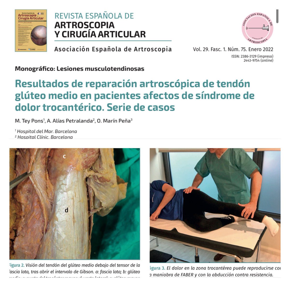 🟣NUEVO ARTÍCULO REACA🟣

✅ Resultados de reparación artroscópica de tendón glúteo medio en pacientes afectos de síndrome de dolor trocantérico.  

‼️ACCESO GRATUITO AL ARTÍCULO COMPLETO‼️

fondoscience.com/file/5687/down…