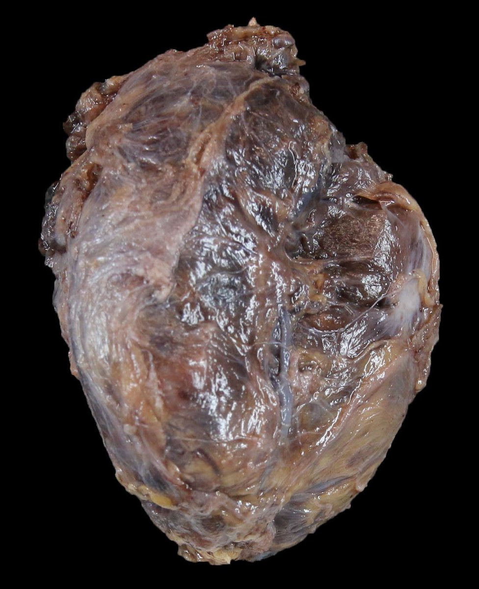 BWHPath's tweet photo. #BWHPathCotW
A middle-aged man has a right thyroid mass (found incidentally). FNA showed papillary thyroid carcinoma, and he underwent thyroidectomy. What additional process is at play here based on the gross photographs? #EndoPath #ENTPath
1/ https://t.co/kMRIs8WpD6