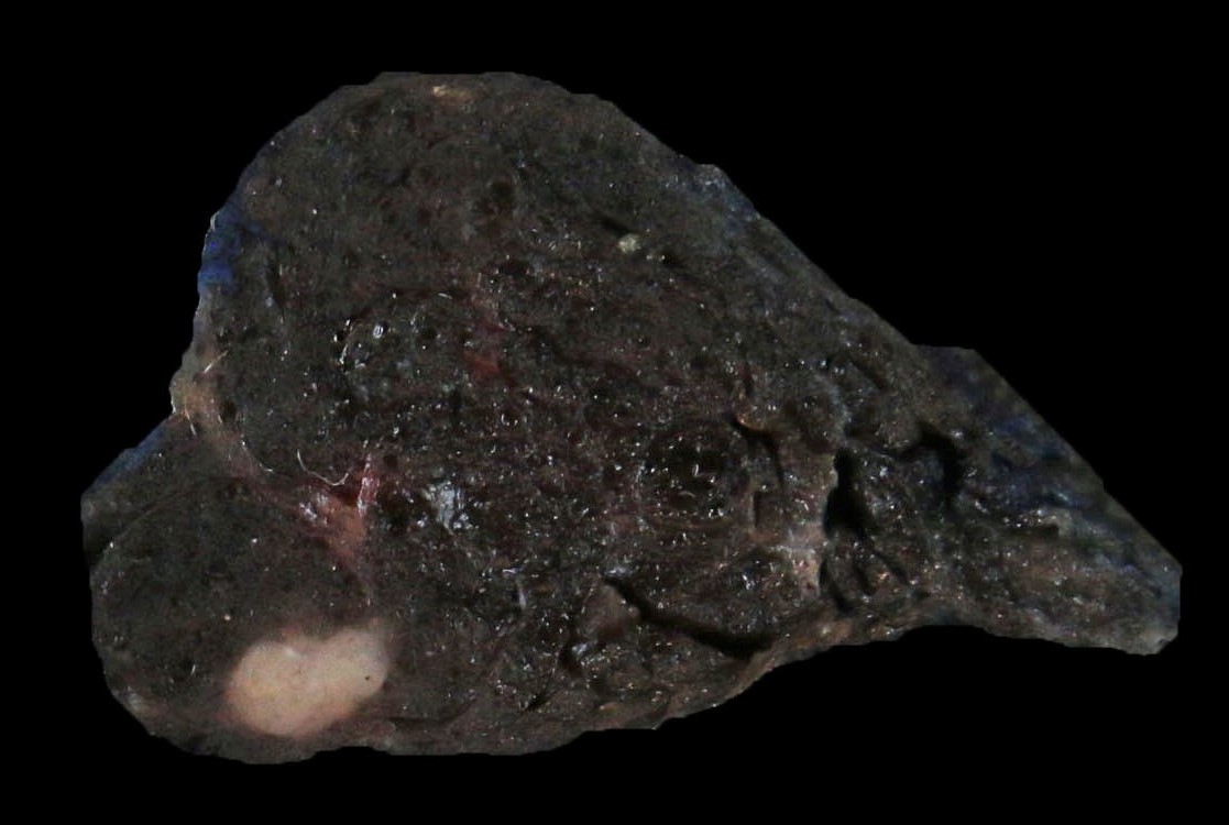 BWHPath's tweet photo. #BWHPathCotW
A middle-aged man has a right thyroid mass (found incidentally). FNA showed papillary thyroid carcinoma, and he underwent thyroidectomy. What additional process is at play here based on the gross photographs? #EndoPath #ENTPath
1/ https://t.co/kMRIs8WpD6