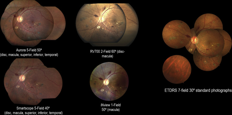 AAOjournal's tweet photo. Handheld retinal imaging devices meet standards for sensitivity and specificity in identifying referable diabetic retinopathy (DR), and achieve substantial levels of agreement for both DR and diabetic macular edema compared with standard ETDRS photography https://t.co/sWUCEfZhhH https://t.co/u1E0exrJbC
