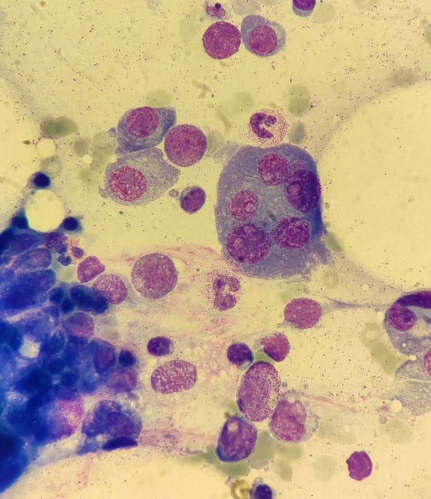 MarieSolangeFl1's tweet photo. Plasmáticas con mucha personalidad: multinuclearidad y presencia de nucleolo(s) #hematology #hematopath #MYELOMA #cytology https://t.co/iyI4Vdljf4