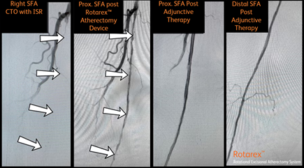 TimHugBD's tweet photo. Rotarex™ Atherectomy Device ISR case. Treated by Dr. Singh. Great Results! @PallaviManvarMD
#RemoveWithRotarex

Not for use in the cardiopulmonary, coronary, carotid, cerebral, renal or venous vasculature. Safety info: https://t.co/KAXyVb6g6h https://t.co/SAYKYZ3C5I