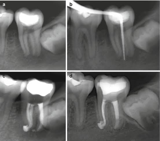 OMDENTALCLINICS's tweet photo. Root canal treatment is a procedure to relieve den..For more info visit...https://t.co/rwiLavv6uS https://t.co/MQF03HmyTJ