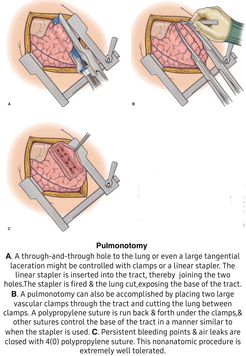 DRAFTABAHMED7's tweet photo. Pulmonotomy:
𝗥𝗲𝗳:Trauma 9th ed.
#Trauma #vascularinjury
#MedTwitter #damagecontrolsurgery
#thoracictrauma
#thoracotomy 
#ribfracture #haemothorax https://t.co/9HfV4U4esT