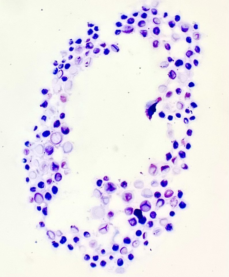 Gloria_SuraMD's tweet photo. Cerebrospinal fluid showing variably sized encapsulated yeasts of Cryptococcus species. #PathTwitter #PathArt #CytoPath #Pathology https://t.co/mopt9uLuP0