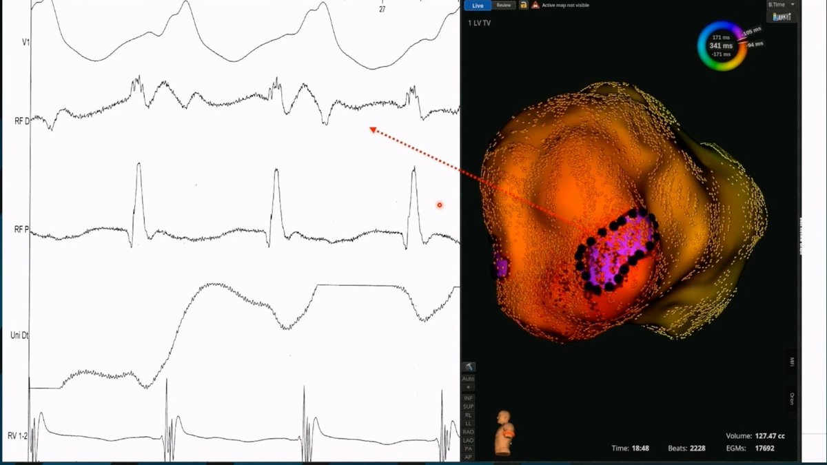 Dr_Ahmed_Ammar's tweet photo. Nice VT ablation case using RHYTHMIA mapping system

#EHRA2022 
#EPeeps https://t.co/QOhhfUzknI