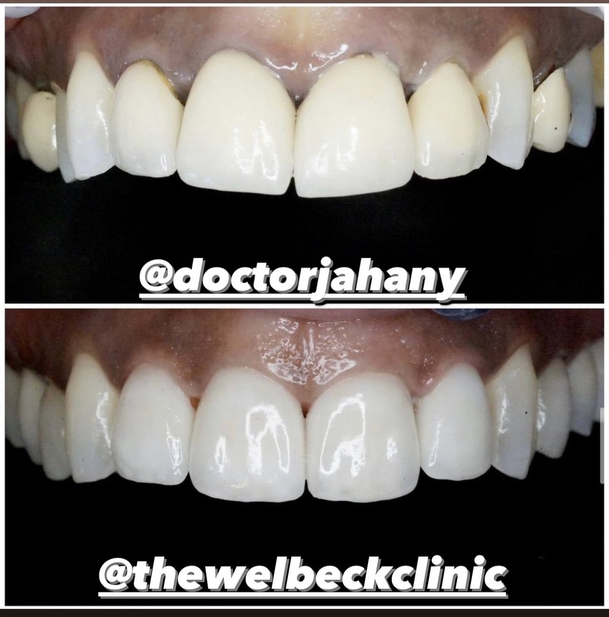 This patient came to the practice to see @doctorjahany wanting more of a natural smile, leaving the canines untouched.

Difficult case due to the character of canines and colour of the enamel and blending the restorations into it.
#smilemakeover #veneers #invisalign