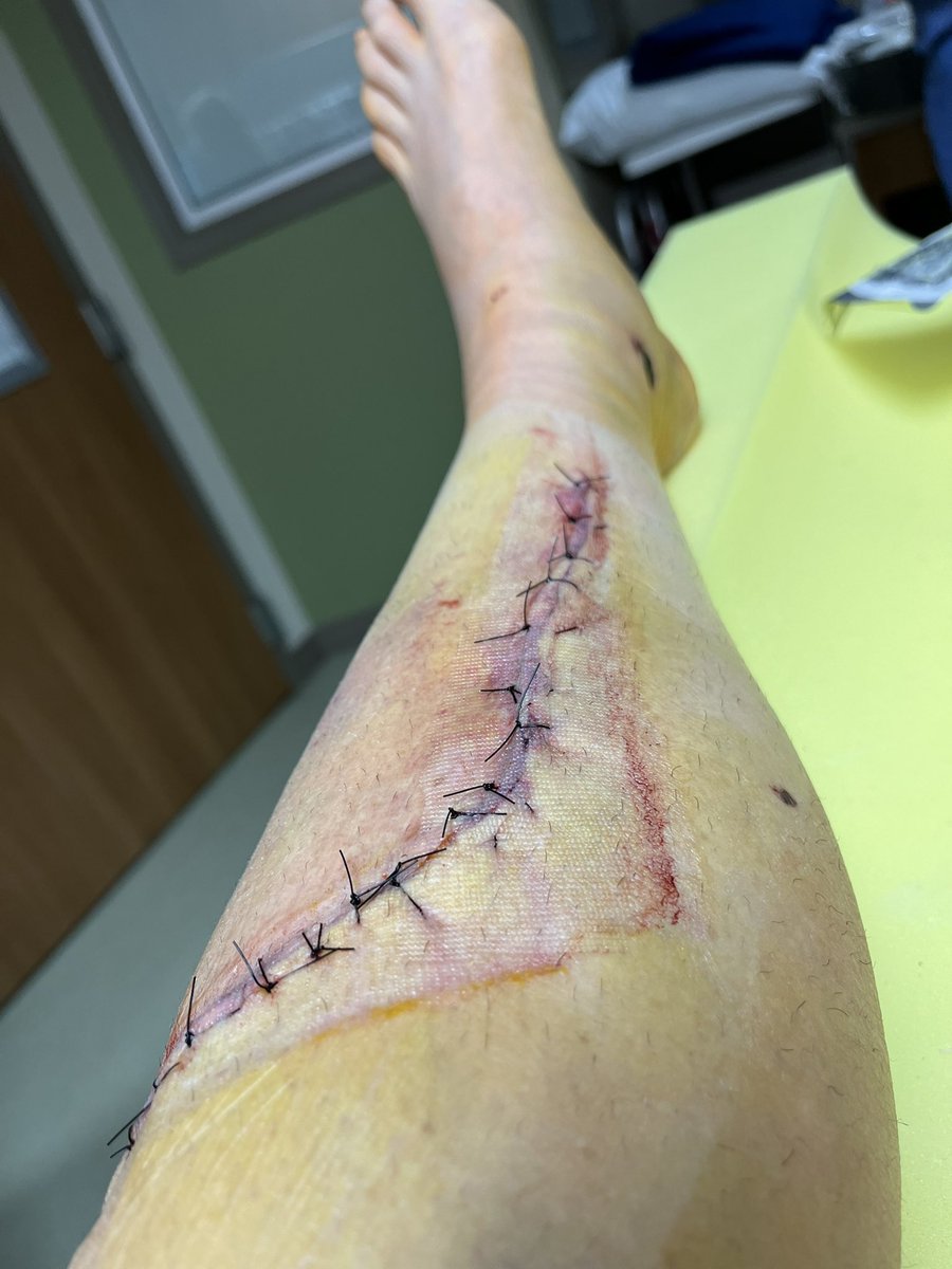 atx_tracy's tweet photo. Phase to recovery post being struck by a vehicle.  Transport to trauma center, surgery, rehab. https://t.co/ii9UbZM7yG