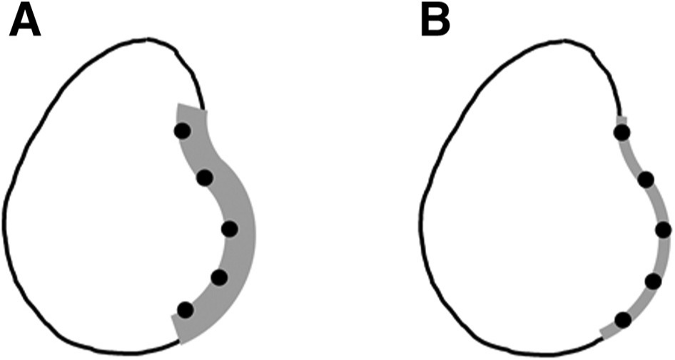 ArthroscopyJ's tweet image. On-the-edge glenoid anchor placement during arthroscopic Bankart repair may be associated with less glenoid rim erosion as compared with on-the-face anchor placement. #arthroscopy #shoulder #labrum ow.ly/8rch50Iz9BW