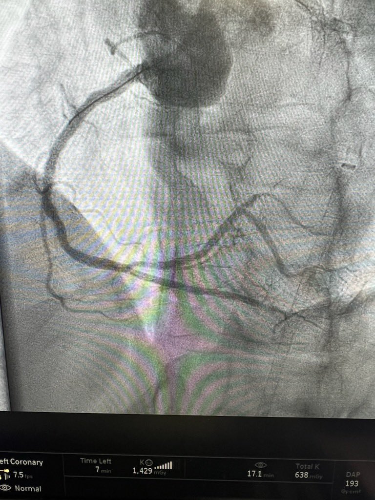 Cto intervention right PDA <a href="/SAIFSanAntonio/">SAIF</a>