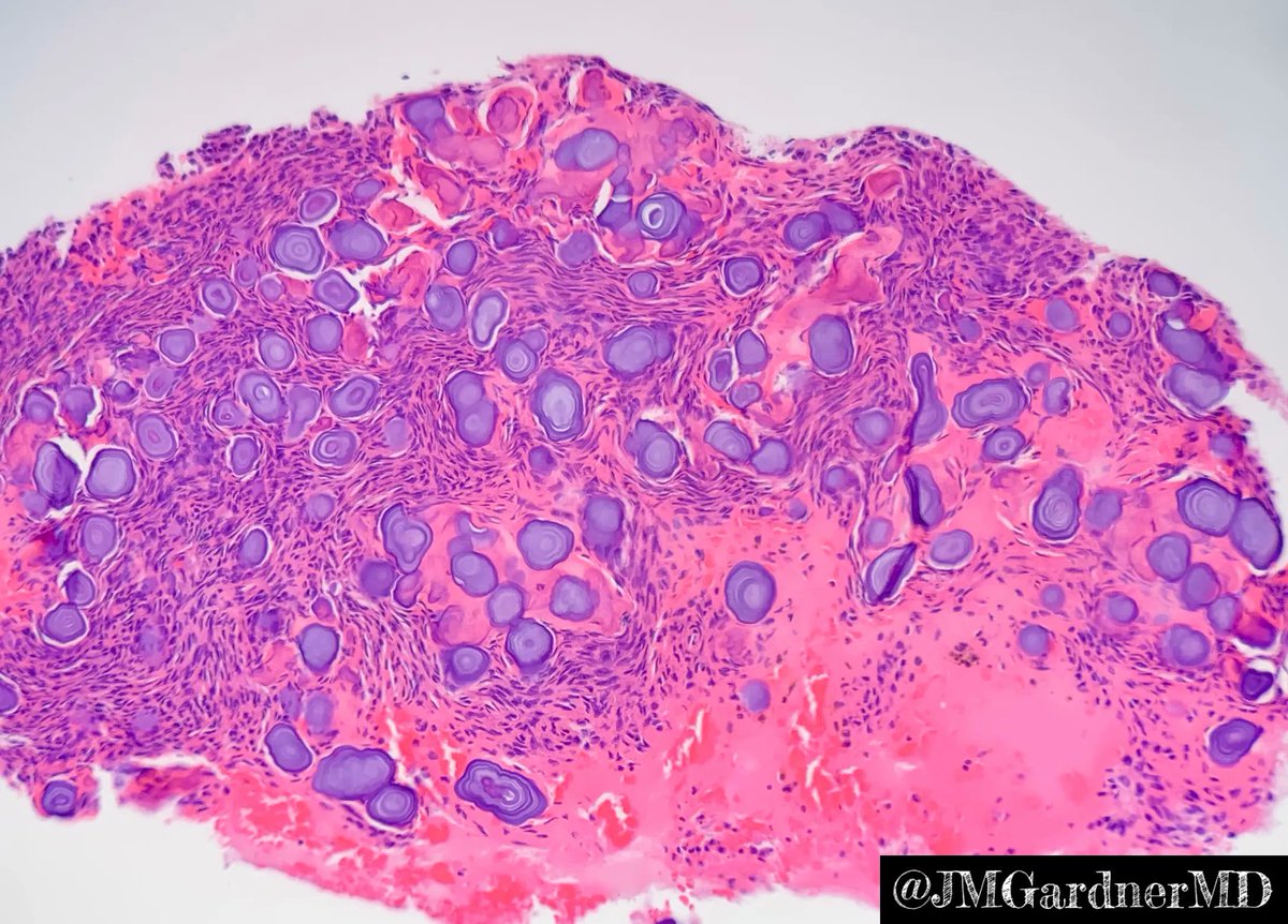 JMGardnerMD's tweet photo. Ethmoid bone lesion in a young girl. Your diagnosis? What are these stunning concentric ring structures??? Answers &amp; more pics: https://t.co/KH7NKozqhQ. Thx to @ConnorZuraski for sharing this case with me! #BSTpath #pathologists #pathology #pathTwitter #oralpath #dental #dentist https://t.co/0J1hfU5bTu