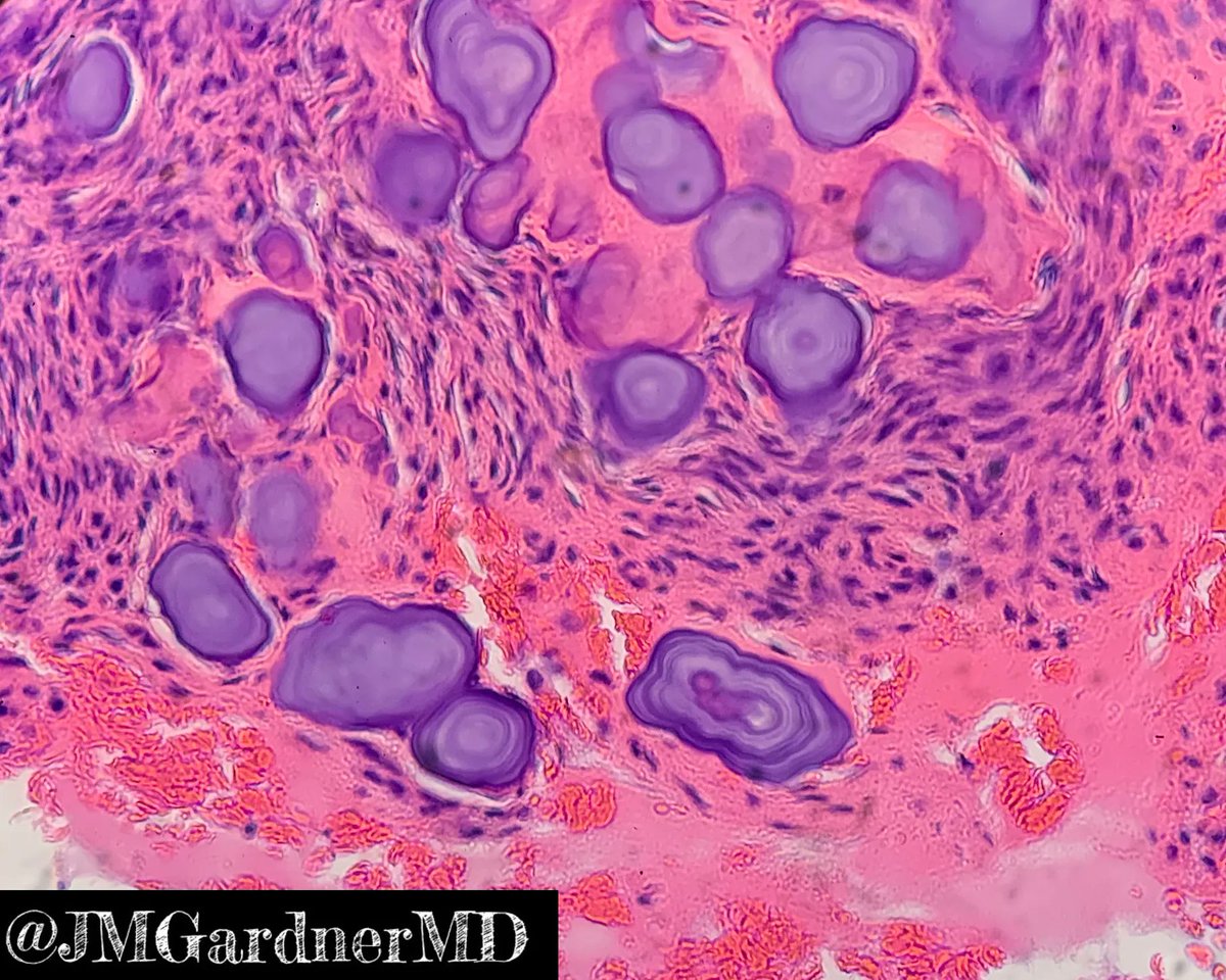 JMGardnerMD's tweet photo. Ethmoid bone lesion in a young girl. Your diagnosis? What are these stunning concentric ring structures??? Answers &amp; more pics: https://t.co/KH7NKozqhQ. Thx to @ConnorZuraski for sharing this case with me! #BSTpath #pathologists #pathology #pathTwitter #oralpath #dental #dentist https://t.co/0J1hfU5bTu