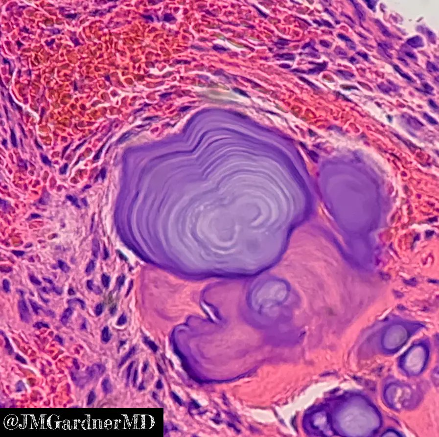 JMGardnerMD's tweet photo. Ethmoid bone lesion in a young girl. Your diagnosis? What are these stunning concentric ring structures??? Answers &amp; more pics: https://t.co/KH7NKozqhQ. Thx to @ConnorZuraski for sharing this case with me! #BSTpath #pathologists #pathology #pathTwitter #oralpath #dental #dentist https://t.co/0J1hfU5bTu