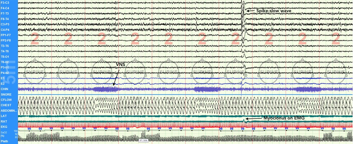 SleepyNeuroDoc's tweet photo. Vagus Nerve Stimulation induced respiratory changes in patient with epilepsy + OSA, "pseudo-periodic breathing"! Titration PSG, 5 min epoch. VNS stimulation results in elevated chin tone, increased breathing rate, lowered airflow and breath effort and no desaturation. #VNS #apnea https://t.co/d8emdldi9g