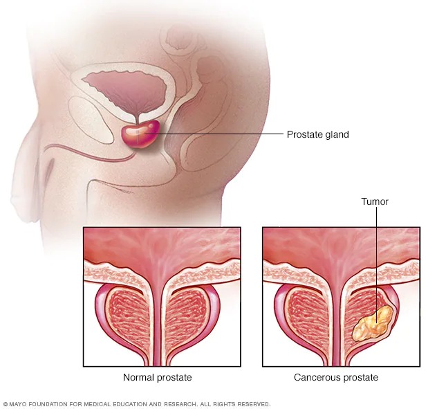 bloompubhealth's tweet photo. #Staffcontribution
✍ by Felix Williams
What do you know about prostate cancer?
📌Prostate cancer is a common type of cancer in males that begins in the prostate gland.
📌The most common risk factor is age. The older a man is, the greater the chance of getting prostate cancer https://t.co/ILelbFiYBJ
