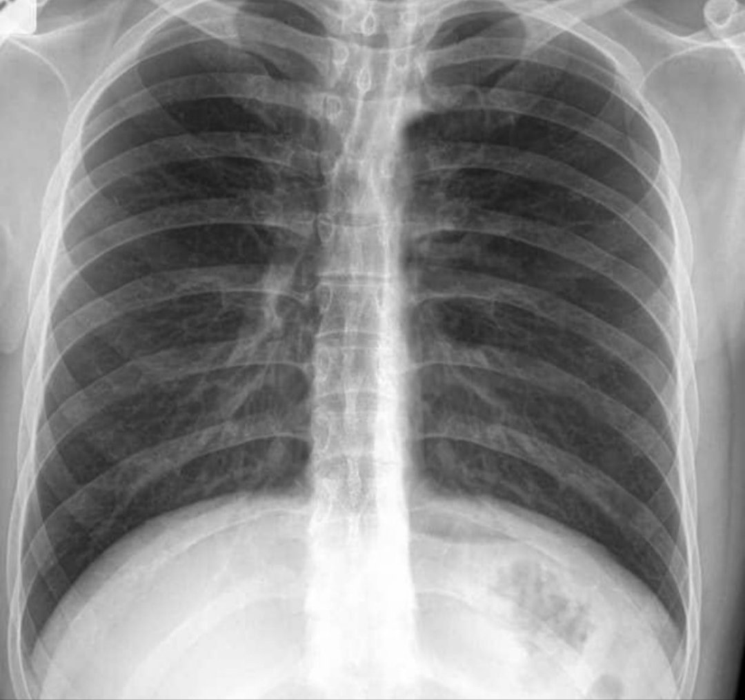 NavodayanDoctor's tweet image. Real chest X-ray of MEDICAL COLLEGE professors..!! 
#MedTwitter
