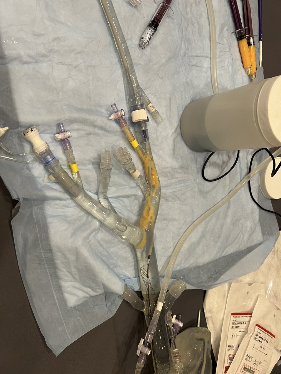 mattsmeds's tweet photo. @LoyolaVascular fellow retrieving clot like a champ at #AVSSSAP @InariMedical @BAulivolaMD https://t.co/hEc1RNSQsB