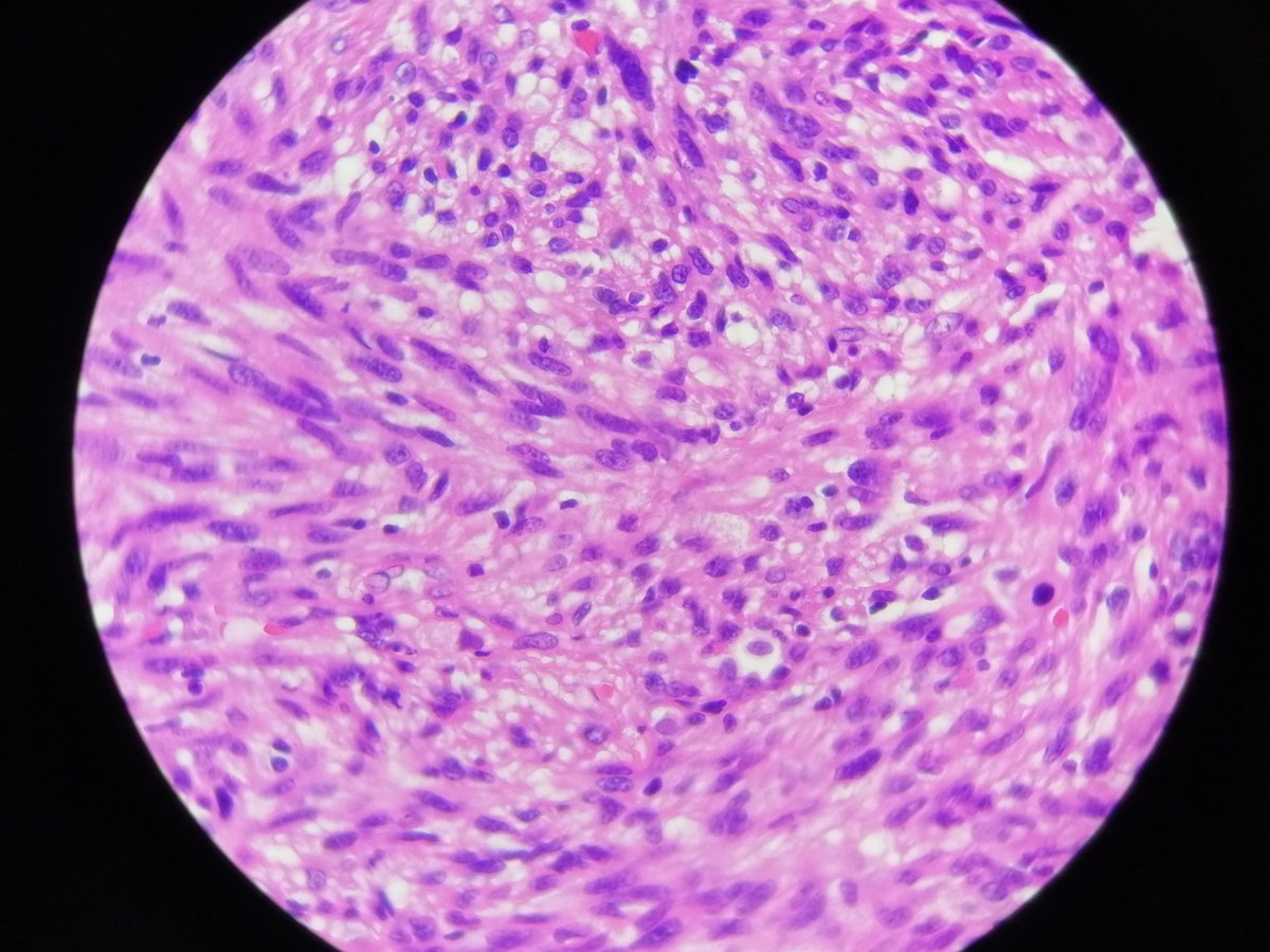 Marisol R.Duque (@histiocita) on Twitter photo Challege of the week : Lung metastasis from....?? 3,2,1 go!!! #pathology #PathTwitter Challege of the week : Lung metastasis from....?? 3,2,1 go!!! #pathology #PathTwitter