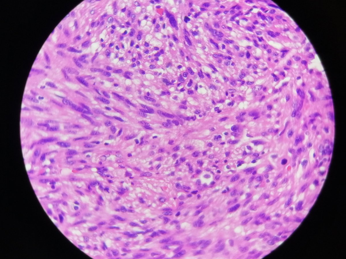 Challege of the week : Lung metastasis from....?? 3,2,1 go!!! #pathology #PathTwitter