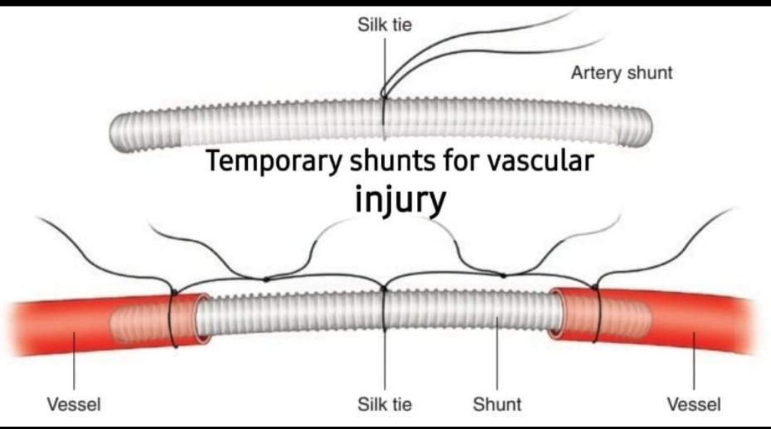 DRAFTABAHMED7's tweet photo. 𝙏𝙚𝙢𝙥𝙤𝙧𝙖𝙧𝙮 𝙨𝙝𝙪𝙣𝙩𝙨 {𝙏𝙚𝙘𝙝𝙣𝙞𝙦𝙪𝙚} &amp; List of Vessel Considerations for Temporary Vascular Shunts:
𝙍𝙚𝙛:-Atlas of Trauma, 2020.
Current surgical therapy 2020.
#Trauma #vascularinjury
#MedTwitter #damagecontrolsurgery
#vascularshunts https://t.co/T8oTIqSEt1
