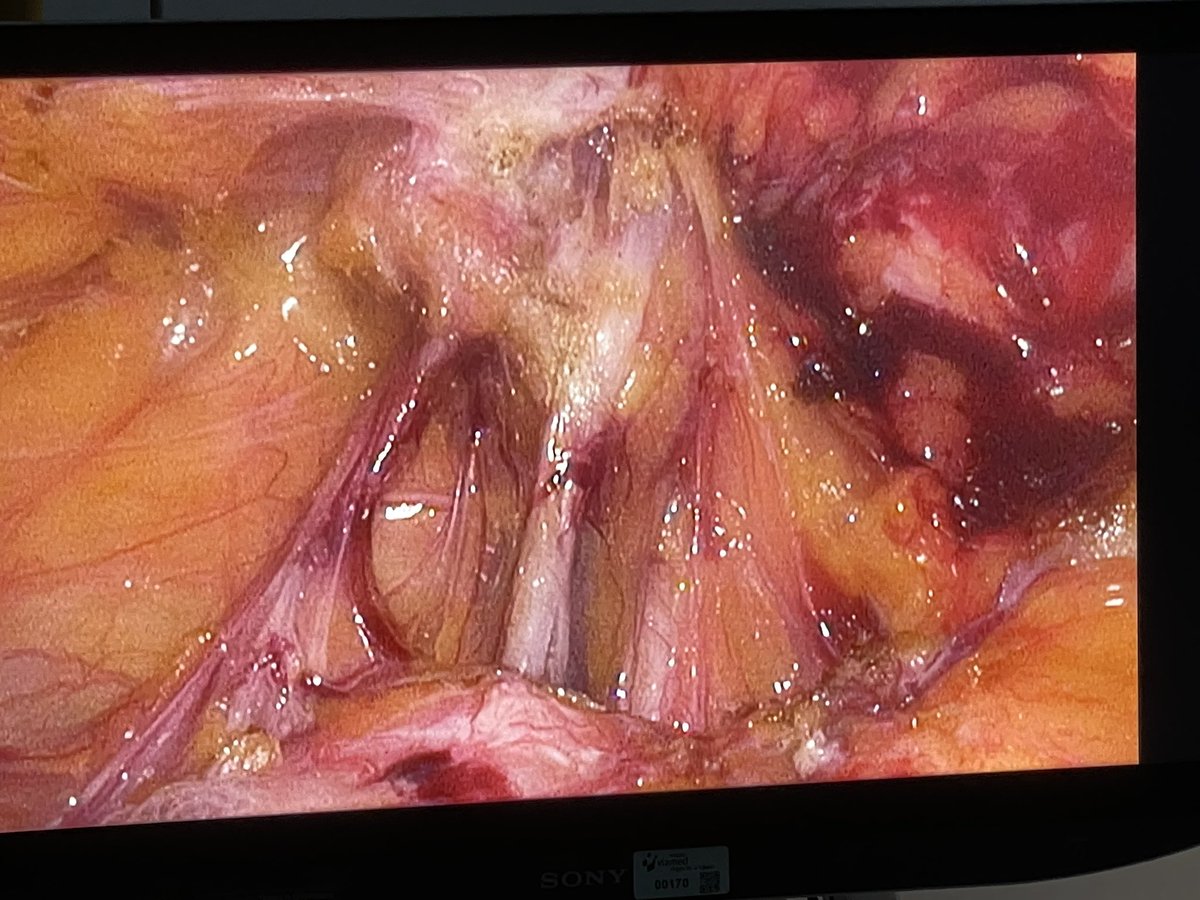 CirLapMadrid's tweet image. Cirugía de esta tarde: varón varón de 75 años. Hernioplastia abierta por hernia inguinal izquierda hace 10 años. Dolor y abultamiento.Ecografía con diagnóstico de recidiva. Abordaje TAPP. Nos encontramos esto👇 (hilo) @paredabdhuis @AecPared @herniasrosario @cgdhuis