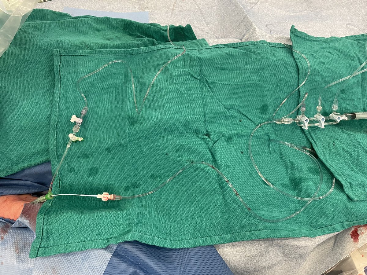RodrigoBagur's tweet photo. Easy simultaneous pressure using @terumoisuk for aortic stenosis severity )when non-invasive assessment is ambiguous of course). R2P 6Fr up to AscAo and a 4Fr JR in the LV https://t.co/hWxfIDiuBS