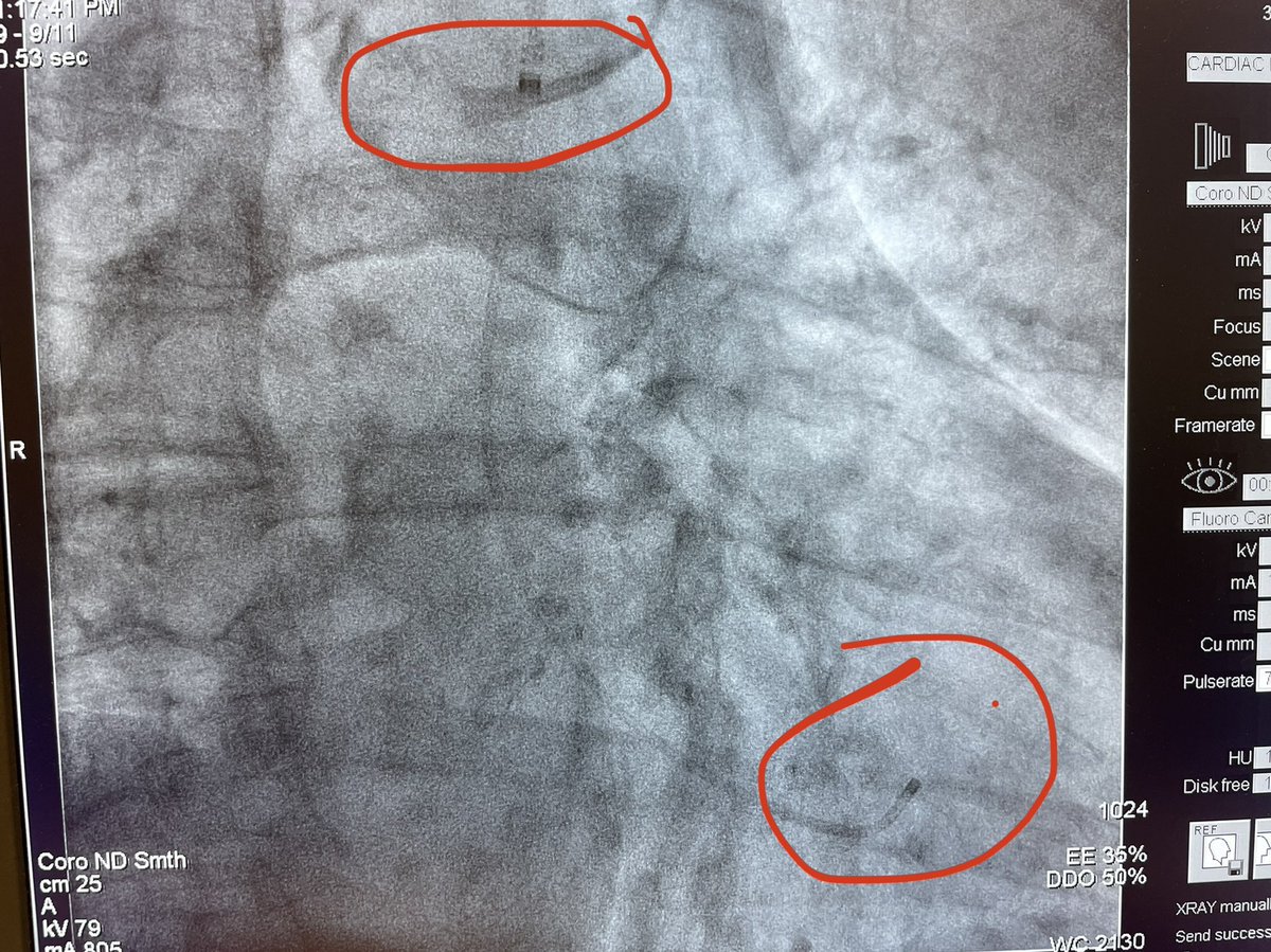 Easy simultaneous pressure using <a href="/terumoisuk/">Terumo Interventional Systems</a> for aortic stenosis severity )when non-invasive assessment is ambiguous of course). R2P 6Fr up to AscAo and a 4Fr JR in the LV