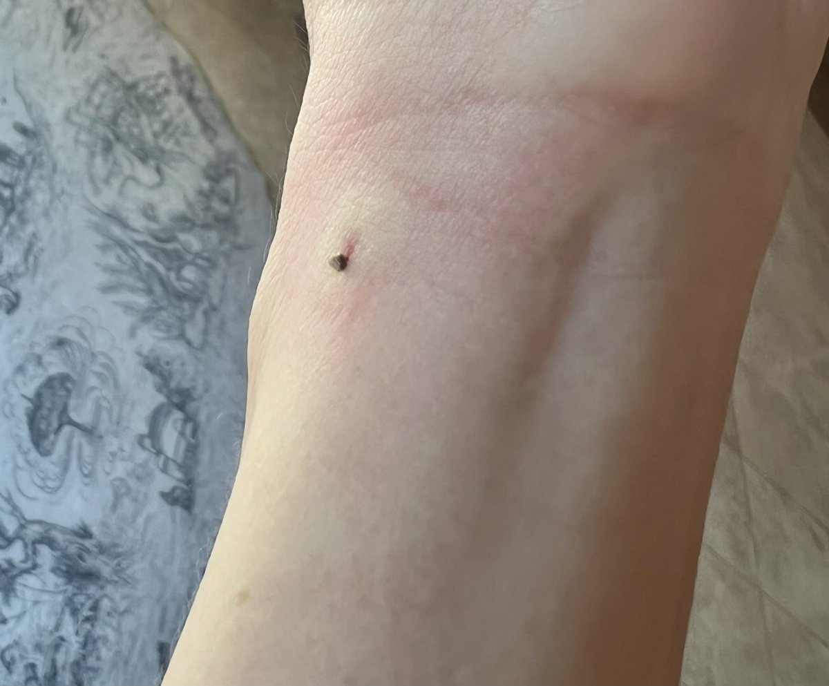 HollyTweet's tweet photo. Just stung myself purposefully in the wrist for apitherapy - ironically, the pain is from opening propolis-stuck hives during bee inspections. Fingers crossed this works! 😅 #sorrybee #beekeepertricks https://t.co/luNFDaSm2R