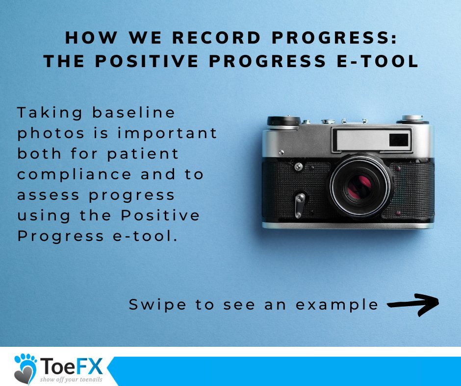 toe_fx's tweet photo. ToeFX is committed to innovation. Our Positive Progress e-Tool uses a computer program to analyze photos and shade the infected area orange (healthy area blue), then calculates the percentage infected.
 #ToeFX #toenailfungus #onychomycosis #chiropodist #podiatrist https://t.co/pkvUOR134b