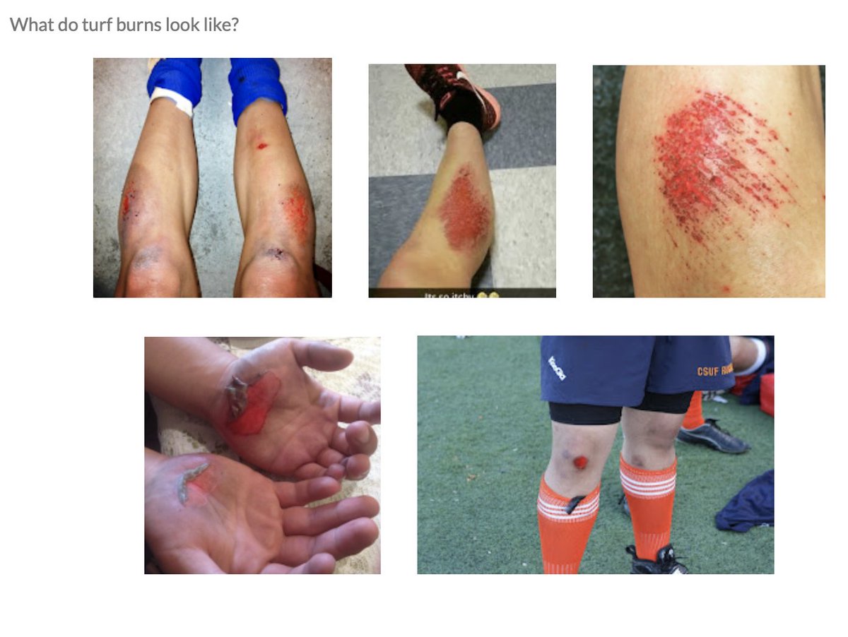 BanPlasticTurf's tweet photo. It also won't be cute when the turf abrasions our kids get become infected.
What's a turf abrasion? It's also known as #TurfBurn.
Check it out here at https://t.co/757LPj8Iqj
How'd you like those open wounds exposed to the crap left on a plastic field? https://t.co/o1kOYIQZYz