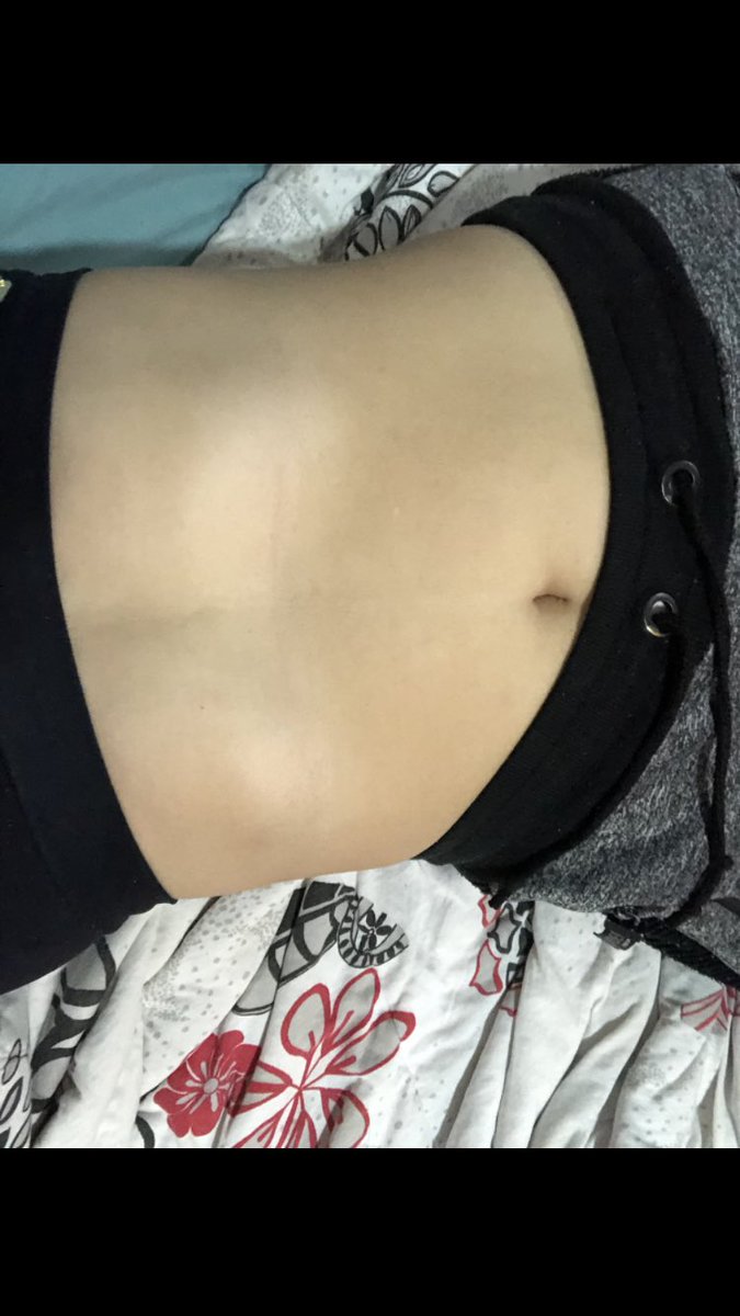 swrrpie's tweet photo. -2kg

vcs tão vendo alguma diferença alem da alergia? https://t.co/XLs6xRwHwh