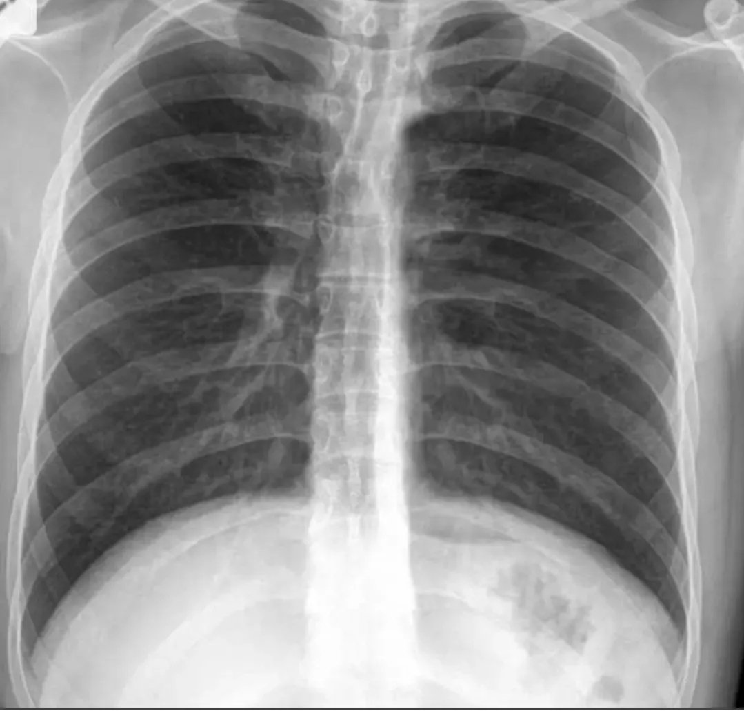 Q8Rheum's tweet photo. What's the abnormality on CXR? https://t.co/F85QpWDHpE