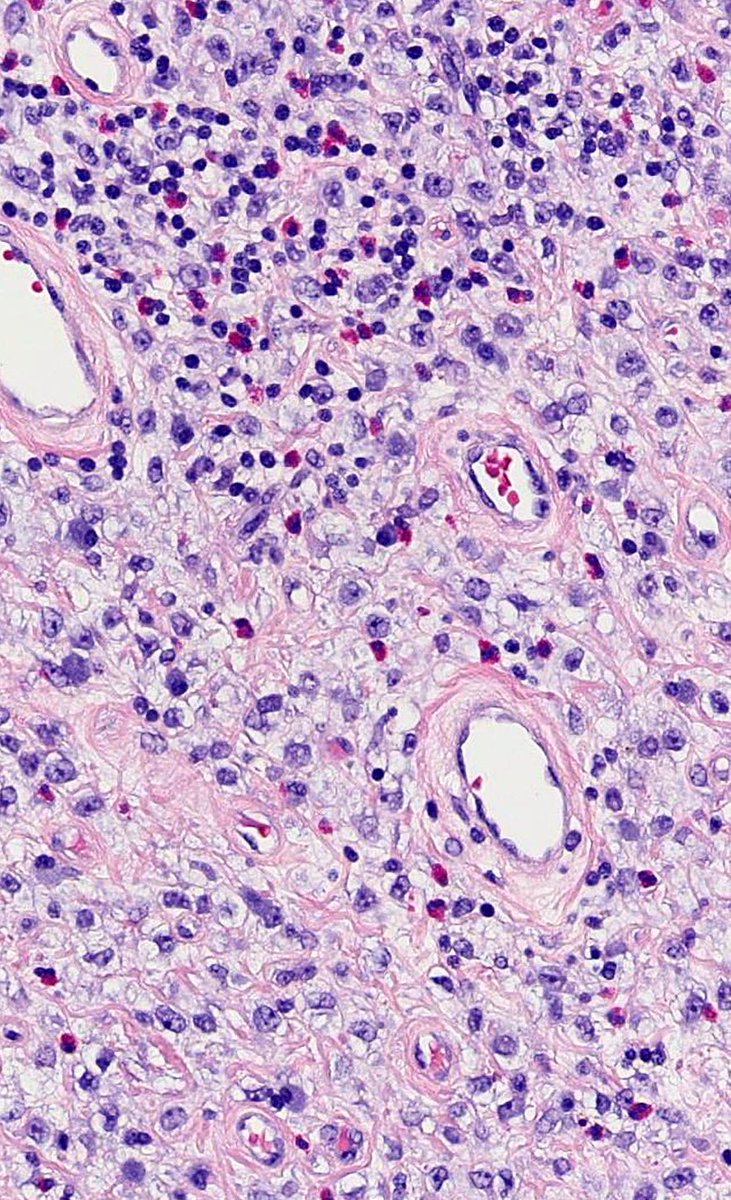 ▪️INFLAMMATORY FIBROID POLYP▪️

• A mesenchymal neoplasm composed of spindle/stellate stromal cells w/ characteristic onion skin arrangement around vessels. 

• Inflammatory infiltrate rich in eosinophils. 

• CD34 positive.

• Associated w/ mutation in PDGFRA gene.

#GIpath