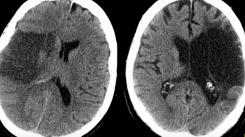 HUInfantaElena's tweet photo. El sistema #Teleictus, implantado en nuestro centro desde 2014, reduce el tiempo hasta el diagnóstico de la embolia, favorece el tratamiento adecuado, optimiza la solicitud de pruebas y evita traslados innecesarios https://t.co/uWjhRY8591 vía @El_Plural https://t.co/F9EmPqHJH1