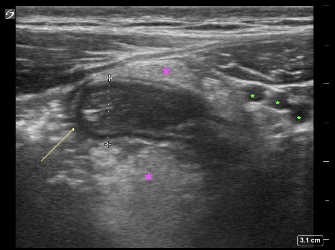 EUSmkh's tweet image. RESOLUTION
S: 9mm structure (yellow arrow)—&amp;gt;inflamed appendix (&amp;gt;6mm, non compressible, no peristalsis, blind ended)
R: pink stars—&amp;gt;inflamed fat, green stars —&amp;gt;inferior epigastric vessels
#raysofgray #POCUS #ultrasound #FOAMed #MedEd #emergencymedicine #medicalstudent #resident