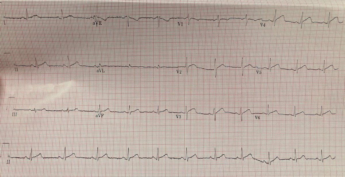 EUSmkh's tweet image. This 50yo F presents with chest pain at 2am.
Students: What is your interpretation of the ECG? 
Residents: What is your next step? 
#raysofgray #POCUS #ultrasound #FOAMed #MedEd #emergencymedicine #medicalstudent #resident